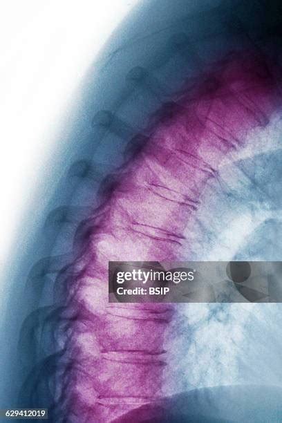 Degenerative Diseases Photos And Premium High Res Pictures Getty Images