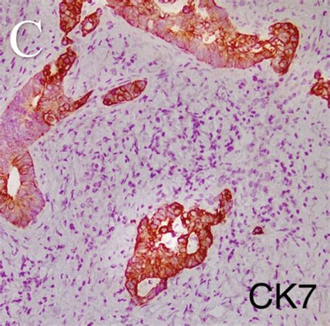 Microscopic Sections Show Metastatic Glands Of Colon Adenocarcinoma Download Scientific