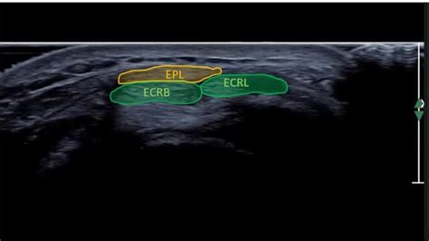 Wrist normal – ULTRASOUNDPAEDIA