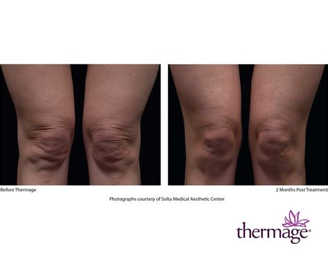 Thermage Flx For Skin Tightening Studiomd