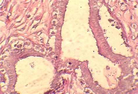 Fibroadenoma De Mama Atlas De Histopatologia