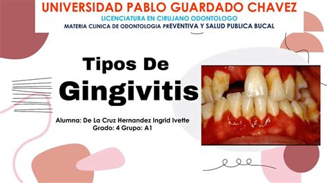 Tipos De Gingivitis Ingrid De UDocz