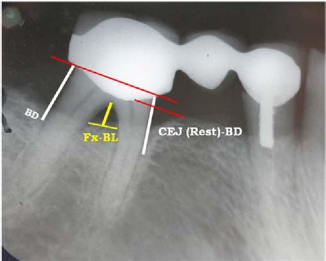 [PDF] CORRELATION OF INTERDENTAL AND INTER- RADICULAR BONE LOSS ...