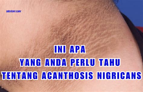 Ini Apa Yang Anda Perlu Tahu Tentang Acanthosis Nigricans Jobstore