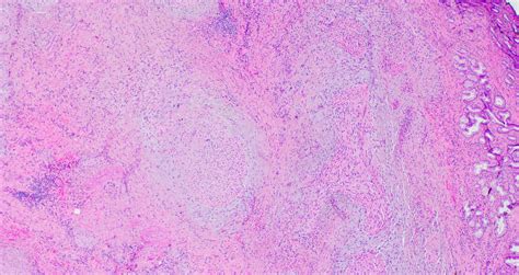 Pathology Outlines Traumatic Neuroma