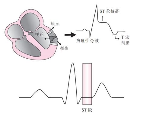 急性心肌梗死的心电图快速定位及临床意义 知乎