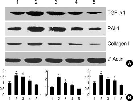 The effect of TGF β1 siRNAs on high glucose induced TGF β1 PAI 1 and