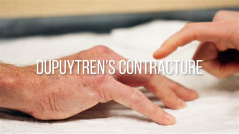 Dupuytrens Contracture Explained Symptoms Causes And Treatments