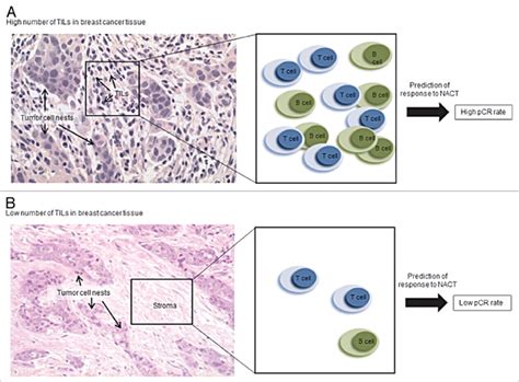 Predictive Value Of Tumor Infiltrating Lymphocytes In Human Breast