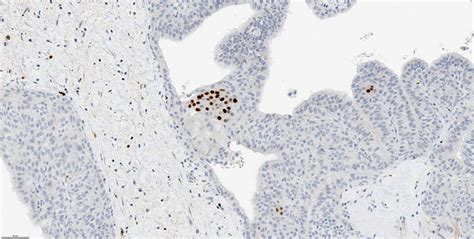 Pathology Outlines Cribriform Morular Thyroid Carcinoma