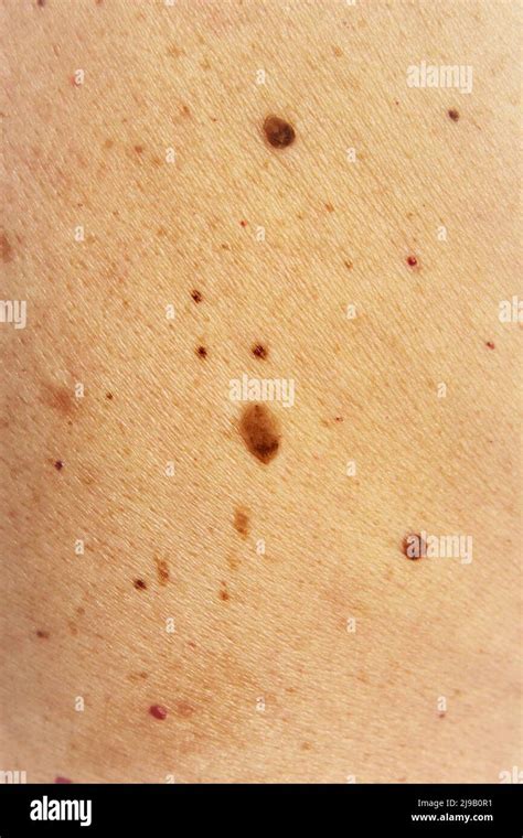 Moles And Birthmark On Human Skin Texture Photo Vertical Full Frame