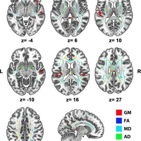 Grey Matter And White Matter Damage In AUD Significant Group