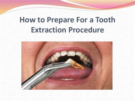 How To Prepare For A Tooth Extraction Procedure