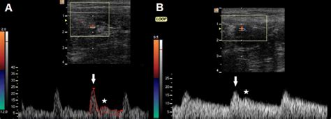 Spectral Doppler Of The Ovarian A And Intraovarian Arteries B In