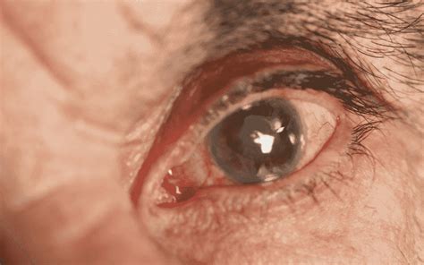 5 Early Signs Of Glaucoma Key Symptoms To Watch For