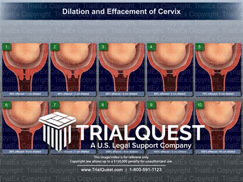 Dilation And Effacement Of Cervix Trialquest Inc