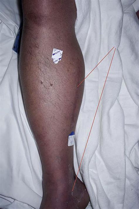 Phlegmasia Cerulea Dolens In A Patient With An Inferior Vena Cava