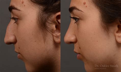 Dr Oakey Smith Top Rhinoplasty Surgeon Toronto Case 418