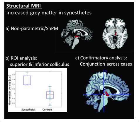 Results Of The Structural Mri Analysis A Voxel Based Morphometry