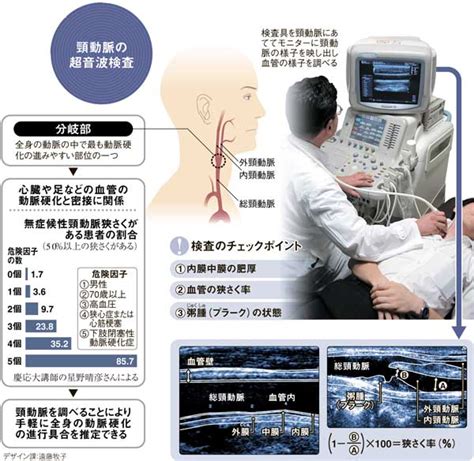 頸動脈、超音波検査で全身の動脈硬化を推定 ヨミドクター読売新聞