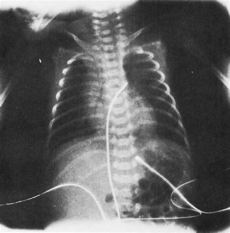 Figure 1 From Neonatal Apnea Associated With Respiratory Distress Syndrome A Case Report