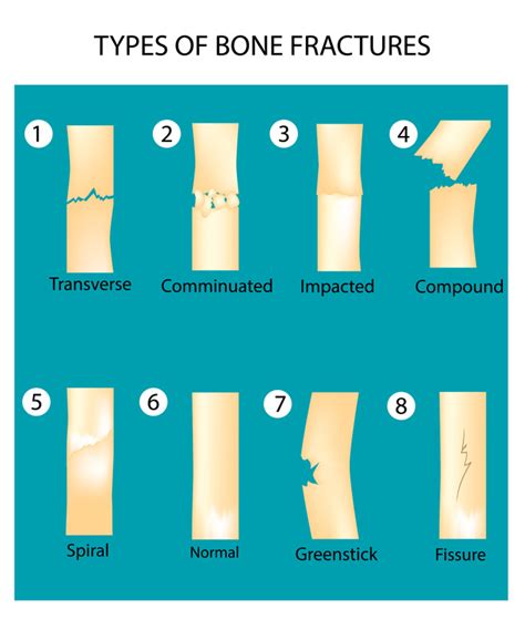 Fracture Types Chart