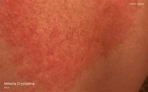 Heat Rash vs. Eczema: How to Tell the Difference | First Derm