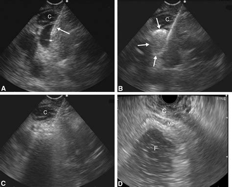 Eus Guided Transesophageal Treatment Of Gastric Fundal Varices With