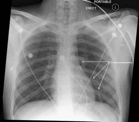 AP chest X-ray showing pneumomediastinum | Open-i