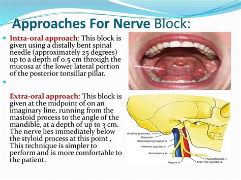 Glossopharyngeal Nerve Block