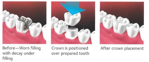 All About Crown Preparation and Placement: With Illustrations