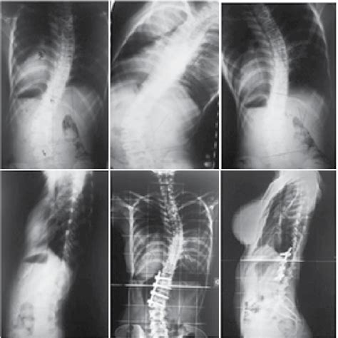 Scielo Brasil Evaluation Of Idiopathic Scoliosis By Anterior And