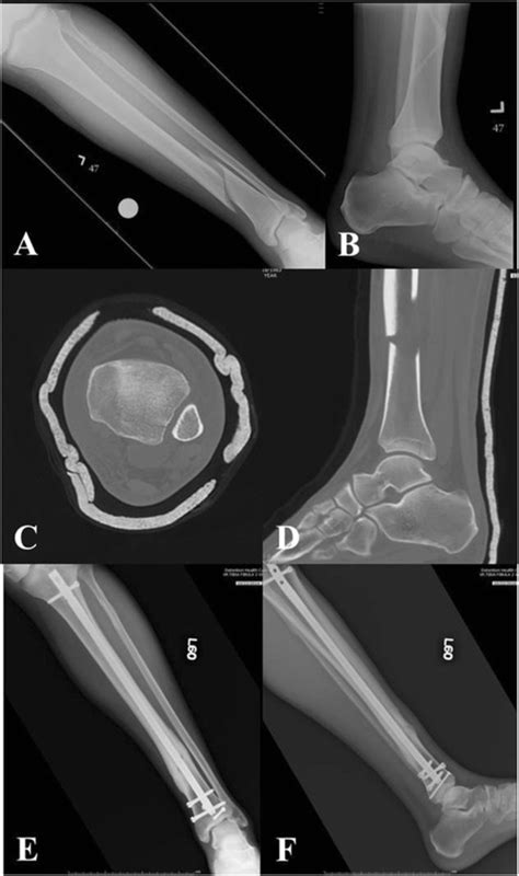 Distal Third Tibia Fracture