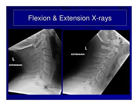 Ct cervical spine flexion extension