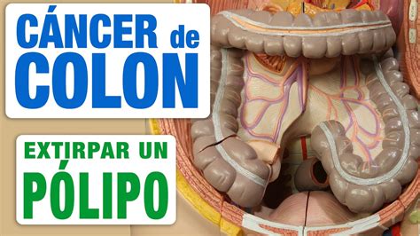 Pólipo en Colon Cómo se extirpa YouTube