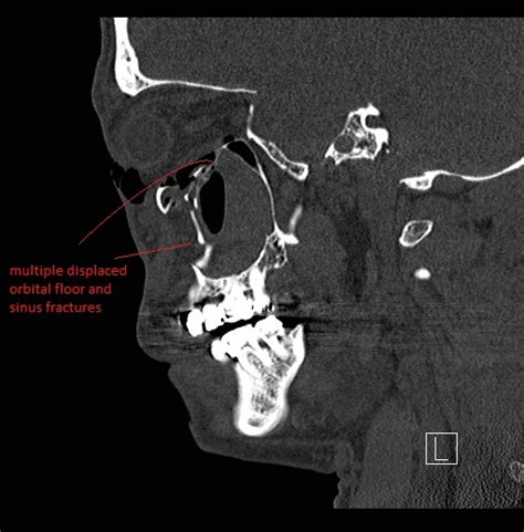 Facial Fracture Induced Periorbital Emphysema Multiple Displaced