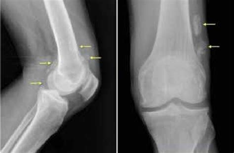 ­ Knee X Rays Show Suprapatellar And Intraarticular Osteochondral