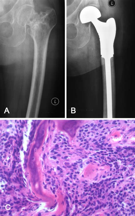 Representative Case Showed Pathological Fracture In Femoral Neck Of