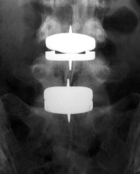 Lumbar Spine Fusion And Stabilization Hardware Techniques And