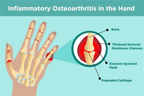 Finger Replacement and Physiotherapy Treatment & Exercise