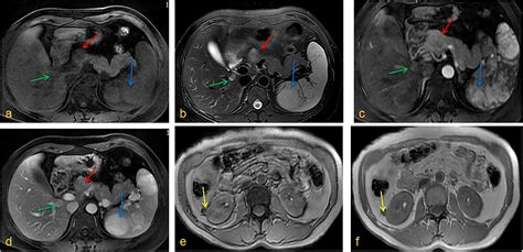 Frontiers Tuberous Sclerosis Complex With Multiple Organ Tumors Case