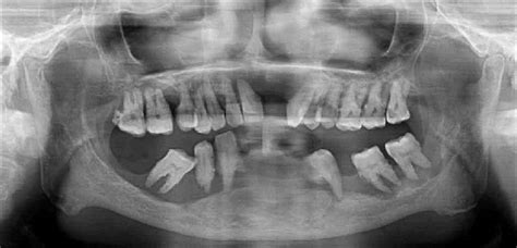 Orthopantomograph Showing Floating Teeth In A Case With Periodontitis