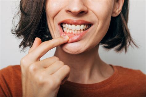 Qué es la gingivitis y cómo prevenirla Clínica Dental Fibemedic