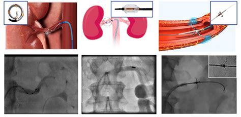 Different Treatment Modalities For Renal Denervation Radiofrequency Download Scientific