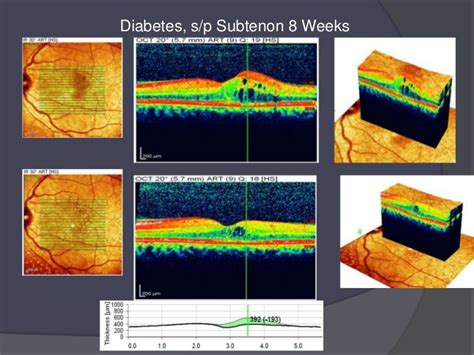 How 3 d oct enhances amd & dme treatment