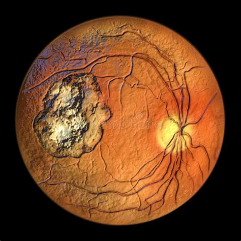 Ocular Toxoplasmosis Retinal Scar Caused By A Toxoplasma Gondii