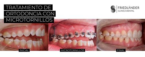 Microtornillos En Ortodoncia Qu Es Cl Nica Friedl Nder