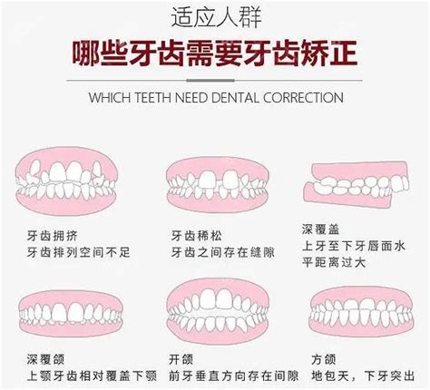 深圳坪山区牙齿矫正一般多少钱坪山隐形矫正牙齿价格2万起牙齿矫正 8682整形网