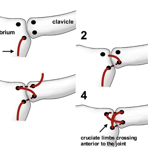 Steps For Left Sternoclavicular Joint Reconstruction With The Patient