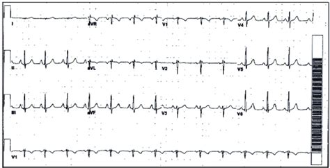 Prior ECG with NSR and normal conduction. ECG: electrocardiogram; NSR ...